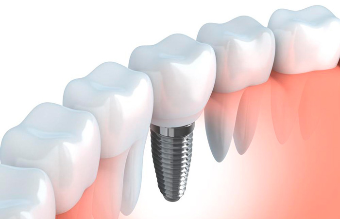 Implantes dentales
